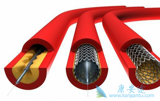 心脏搭桥 心脏搭桥