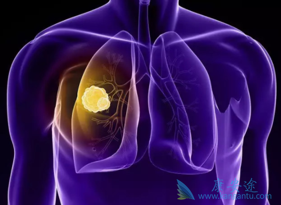 肺癌晚期 肺癌晚期