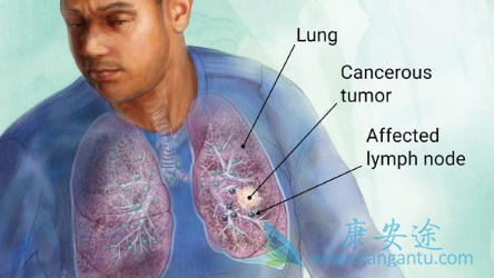 小细胞肺癌 小细胞肺癌