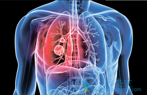 癌症病人吃什么 癌症病人吃什么