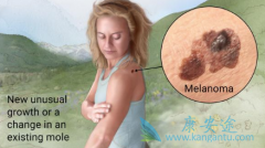 Binimetinib����NRASͻ���ɫ�������ߵ��ٴ�����Ч����ô����