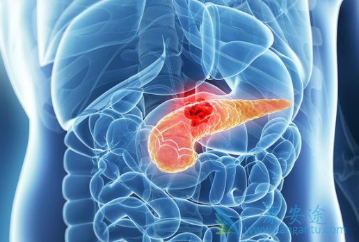 胰腺癌 胰腺癌