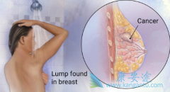 ���������ٰ���ҩsacituzumab govitecan��δ�����׼����