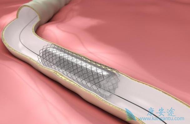 心脏支架 心脏支架