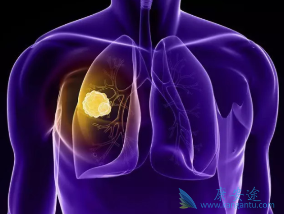 非小细胞肺癌 非小细胞肺癌