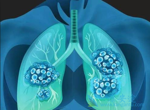 转移性肺癌 转移性肺癌