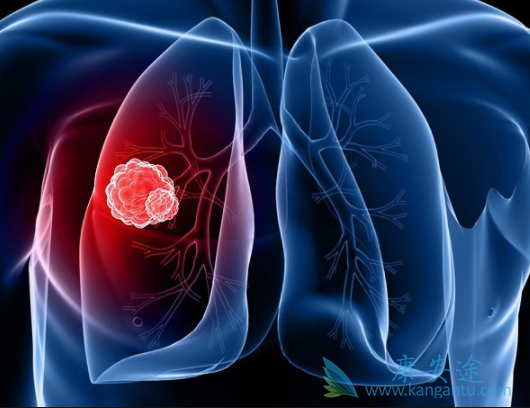 肺癌的治疗 肺癌的治疗