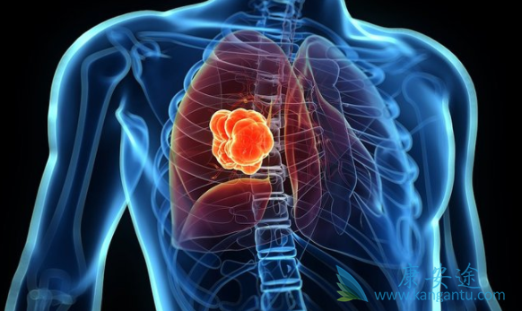 治疗肺癌 治疗肺癌