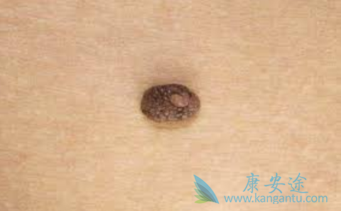 皮肤肿瘤 皮肤肿瘤