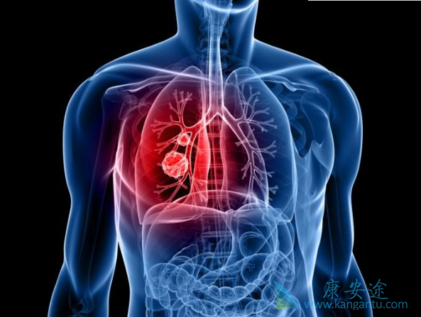 肺癌脑转移 肺癌脑转移