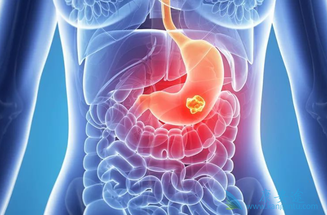 胃肠道间质瘤 胃肠道间质瘤