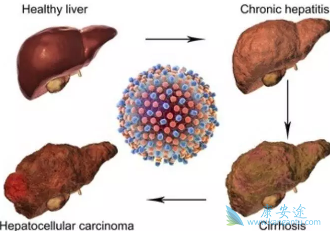 丙肝的治疗方法 丙肝的治疗方法
