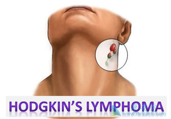 非霍奇金淋巴瘤 非霍奇金淋巴瘤
