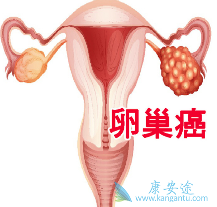 卵巢癌患者 卵巢癌患者