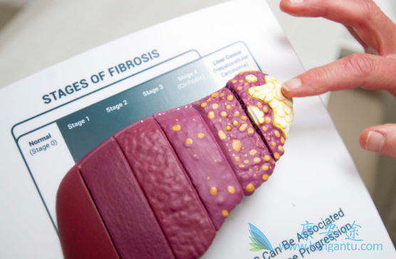 丙肝的治疗 丙肝的治疗