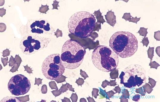 骨髓增生异常综合症 骨髓增生异常综合症