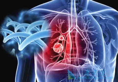 肺癌 肺癌