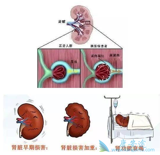 糖尿病肾病的危害有哪些?该如何有效治疗?