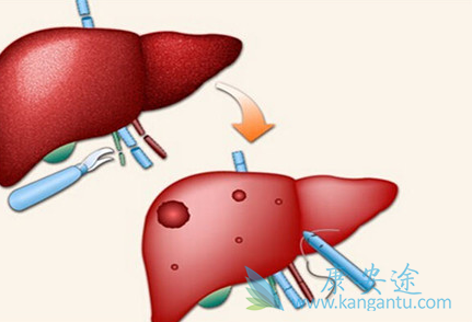 丙肝窗口期 丙肝窗口期