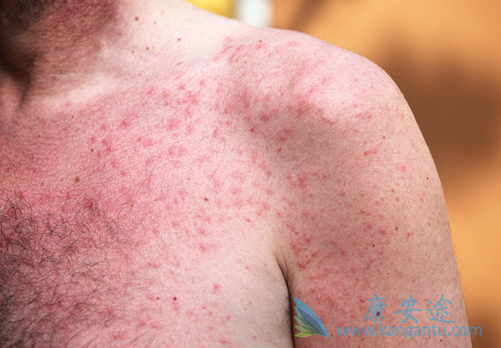 吉非替尼治疗肺癌造成的过敏性皮疹好处理吗?