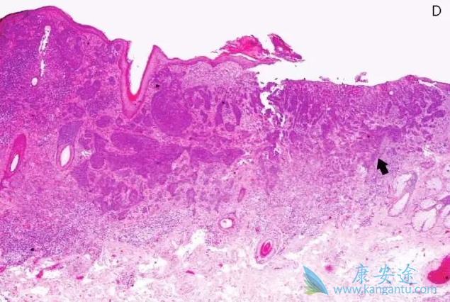 基底细胞癌 基底细胞癌