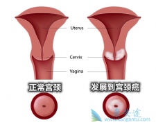 HPV����ֻ��Ԥ����������������Ҫ��HPV������