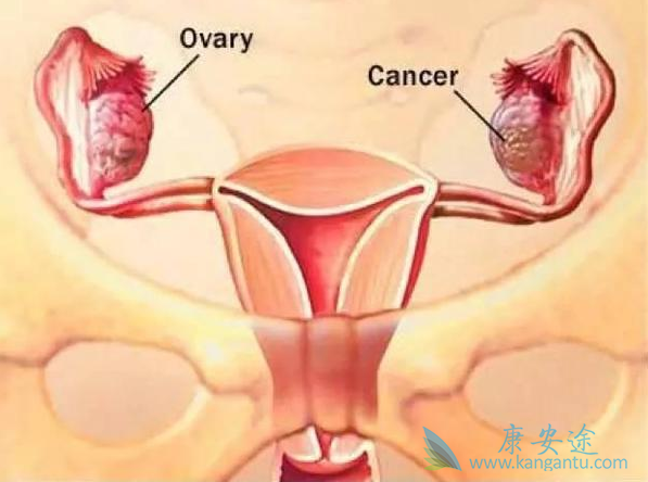 卵巢癌的症状 卵巢癌的症状