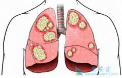 ���ȺͿ�Ѫ�Ƿΰ�����֢״��