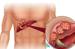 �ΰ�������ʲô֢״���ΰ���������֢״����Щ���ΰ�������֢״��ȫ