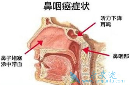 鼻咽癌能治好吗 鼻咽癌能治好吗