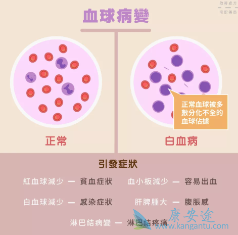 白血病的早期症状有哪些 白血病的早期症状有哪些