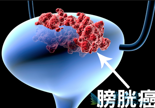 膀胱癌 膀胱癌
