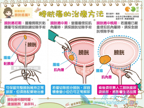 膀胱癌的早期症状 膀胱癌的早期症状