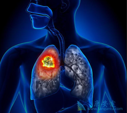 肺癌晚期可以治好吗 肺癌晚期可以治好吗