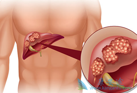 原发性肝癌 原发性肝癌
