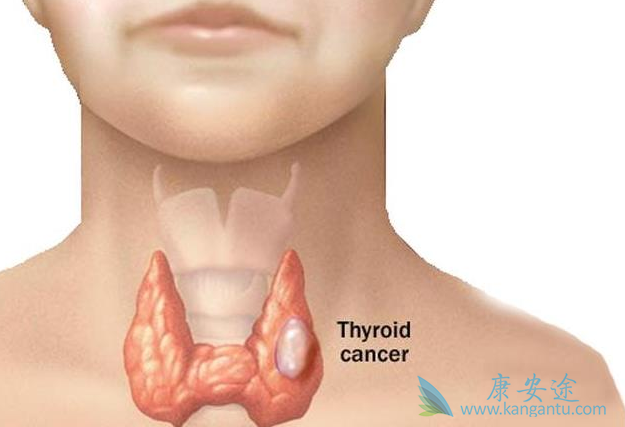 甲状腺肿瘤严重吗 甲状腺肿瘤严重吗