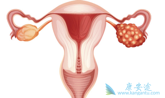 晚期卵巢癌患者 晚期卵巢癌患者