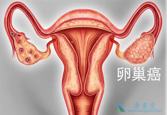 卵巢癌的分期 卵巢癌的分期