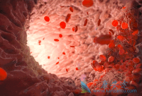 慢性粒细胞白血病 慢性粒细胞白血病