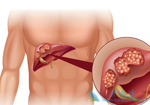 肝癌 肝癌
