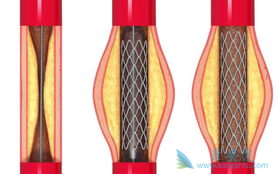 心脏支架手术 心脏支架手术