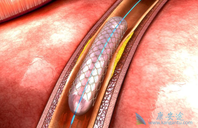心脏支架 心脏支架