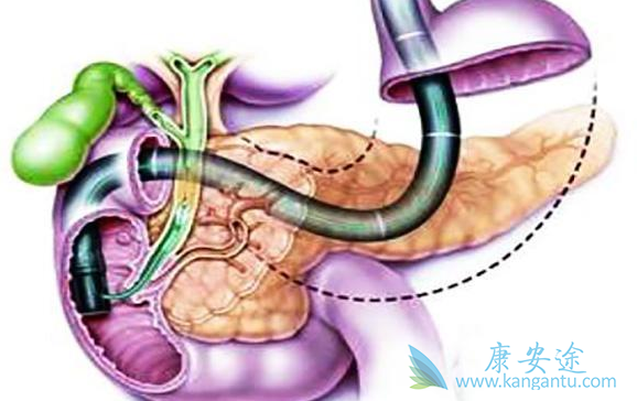 胰腺癌的治疗 胰腺癌的治疗