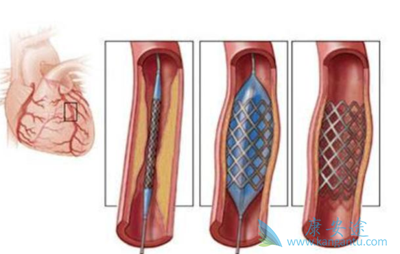 心脏支架手术 心脏支架手术