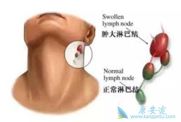 非霍奇金淋巴瘤 非霍奇金淋巴瘤