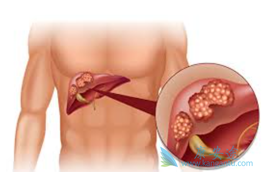 肝癌能治好吗 肝癌能治好吗