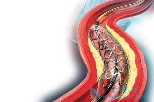心脏支架 心脏支架