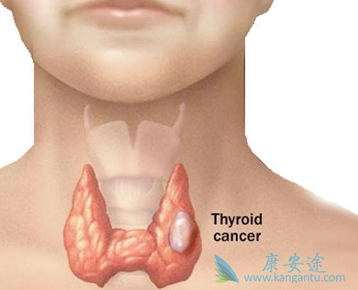 甲状腺癌 甲状腺癌