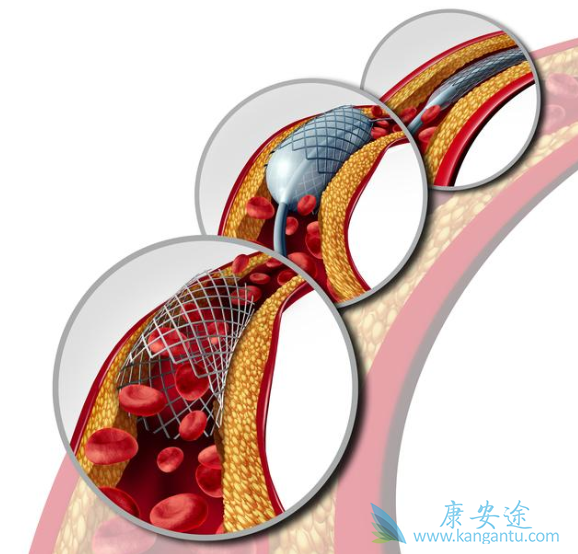 心脏支架 心脏支架