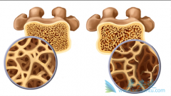 ˫�����ζԶ�ͯ�ɹǲ�ȫ֢��Ч��ô����